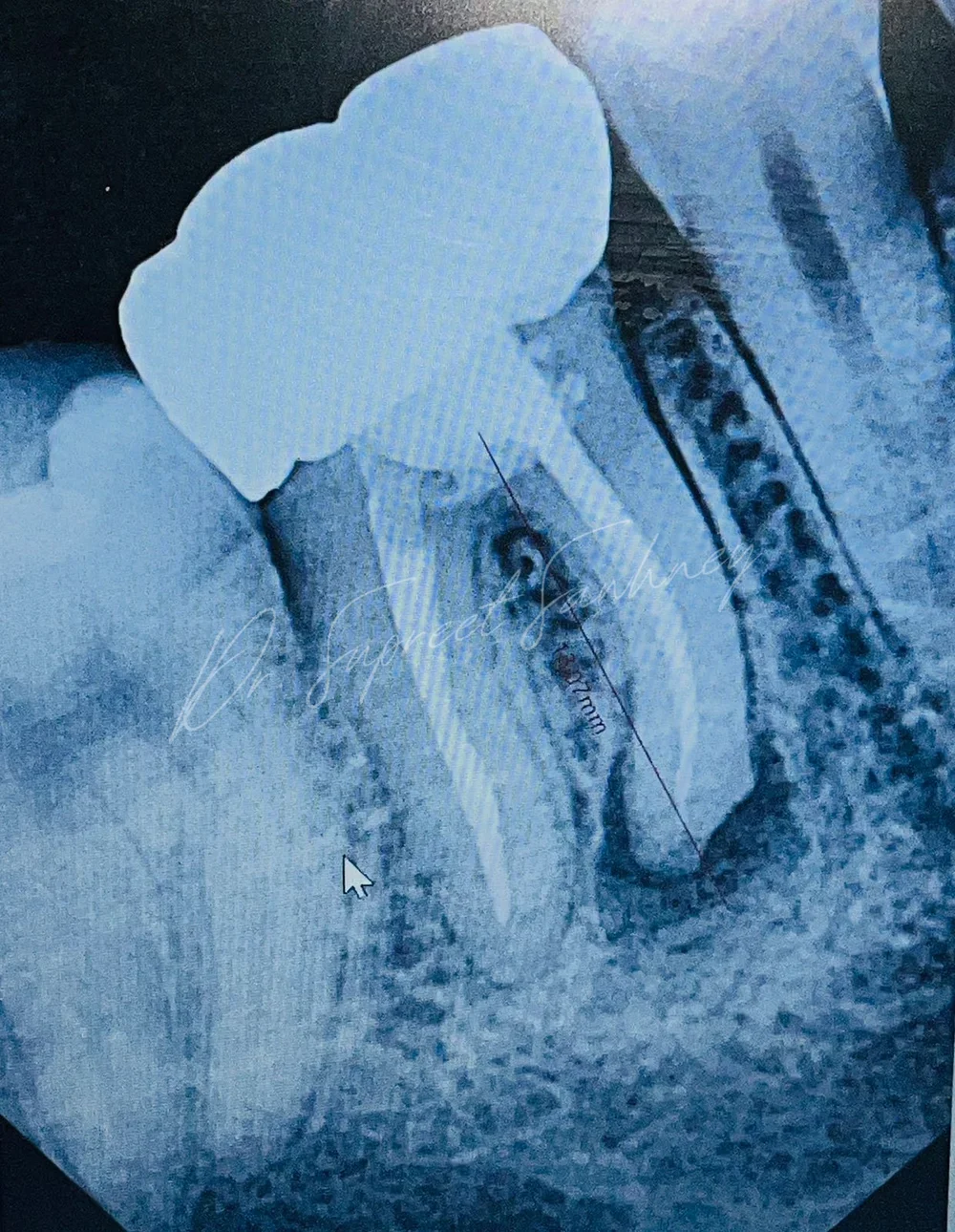 Periapical radiograph of posterior mandibular teeth and the implant treatment site